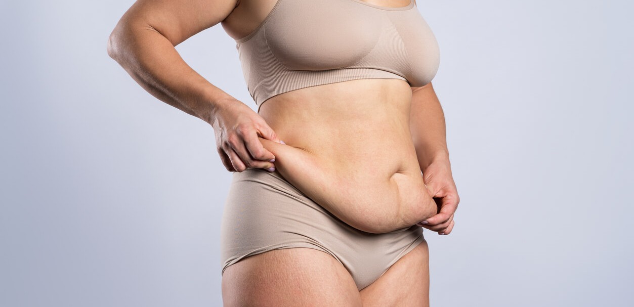 Frau zeigt ihren Bauch vor der Bauchdeckenstraffung in Aachen