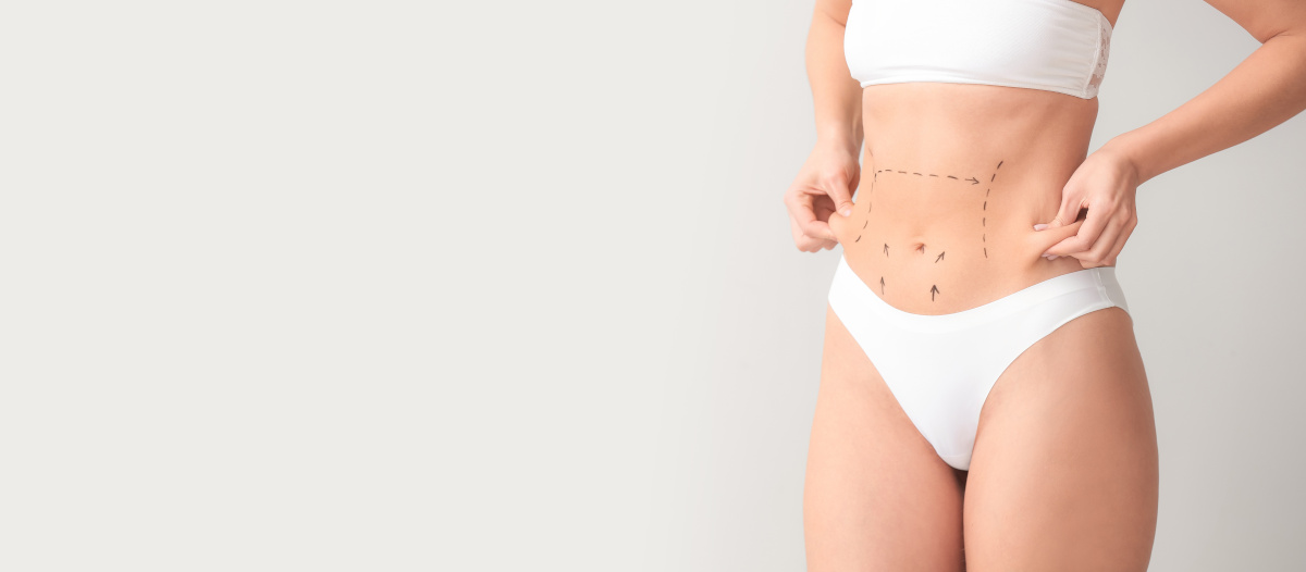 Frau nach Bauchdeckenstraffung in Köln